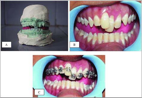 Clinical Images Showing A Functional Posterior Bite Plane On