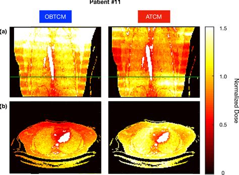 Table 4 From A Comparison Of Breast And Lung Doses From Chest Ct Scans