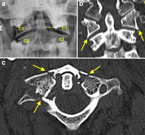 Jefferson fracture - Radiology at St. Vincent's University Hospital