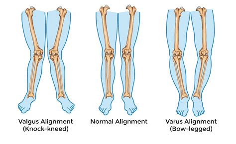 Osteoarthritis Of The Knee Can Result In Knock Knees Or Bowed Legs Often Treated With An