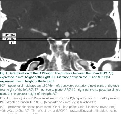 Figure 1 From Morphometry Of The Posterior Clinoid Process And Dorsum Sel Lae Morfometrie Proces