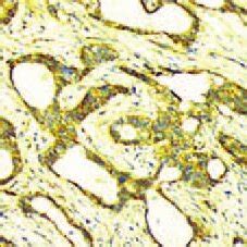 The Expression Of Aqp Vegf And Mvd In Gastric Cancer A