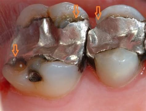 Should Silver Fillings be Replaced? | beverlyhillsladentist.com