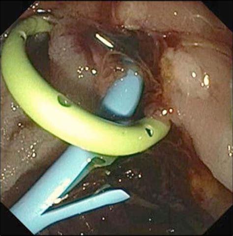 Stent in the main pancreatic duct (yellow) and the common bile duct (blue). | Download ...