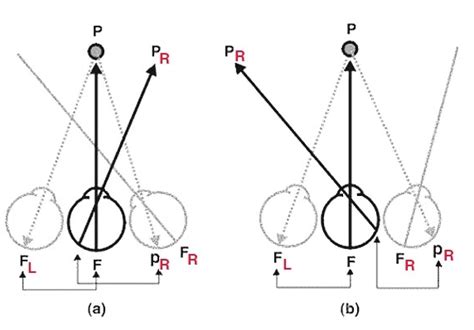 Figure 7 A Uncrossed Diplopia With An Esotropia B Crossed