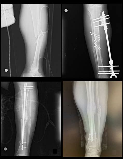 Year Old Male Femur Fracture A Fracture Radiography B