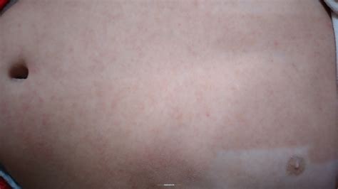 Ask a Pediatrician Online for Prickly Heat Rash From 3 Weeks