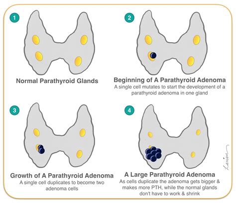 Parathyroid Ultrasound Anatomy