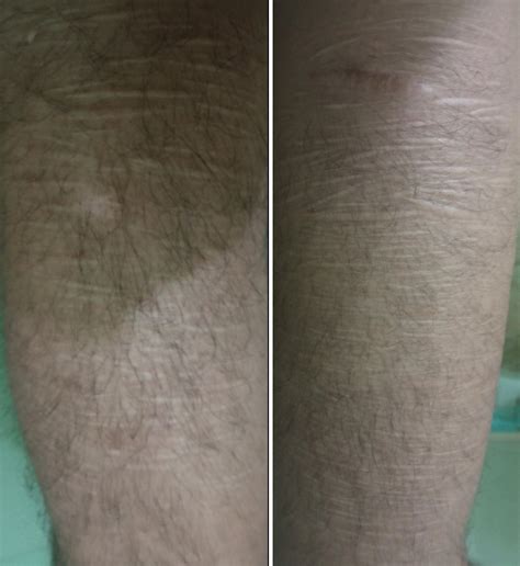 how remove scars from face 3