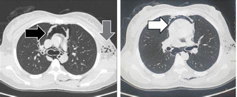 Ct Scan Axial Views Showing Pneumomediastinum Black Arrow