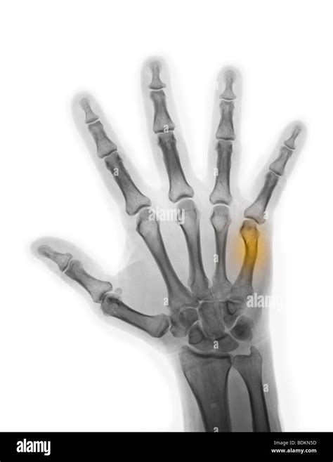 x-ray showing a healing boxer's fracture in a 56 year old man Stock Photo - Alamy