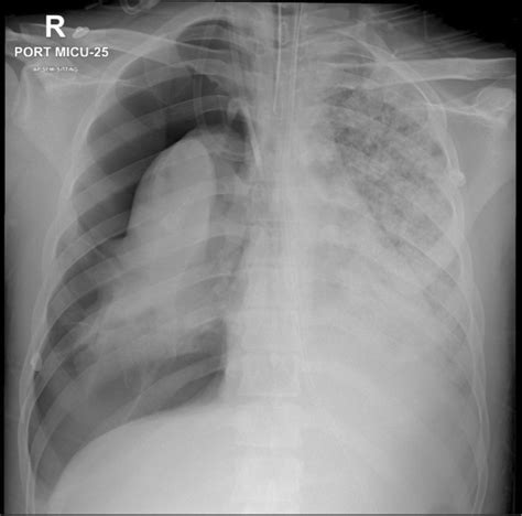 Progression Of The Necrotizing Pneumonia Showing The Development Of