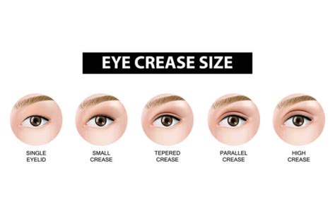 My Double Eyelid Surgery Review And Results Grace Chua