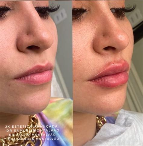 Topo Imagem Boca Rosa Antes E Depois Da Lipo Br Thptnganamst Edu Vn