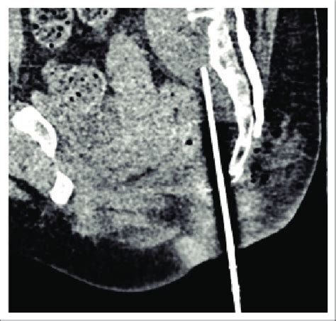 Oblique Sagittal Multiplanar Reconstruction Image Indicating The 18G