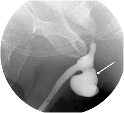 Fluoroscopic Retrograde Urethrogram Shows A Large Diverticulum At The Download Scientific