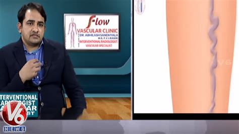 Reasons Treatment For Varicose Veins Problems Dr Abhilash Sandhyala