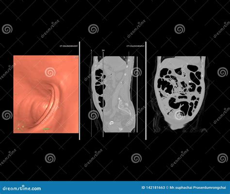 CT Colonography or CT Scan of Colon 3D Rendering Image. Stock Image - Image of biology, abdomen ...