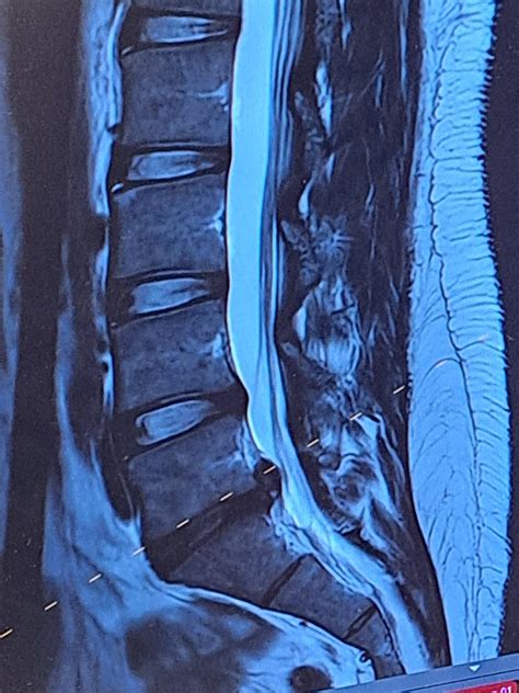 L5/S1 disc protrusion : r/Sciatica