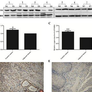 PADI4 Expression In GC Tissues PADI4 Expression Levels In GC Tissue