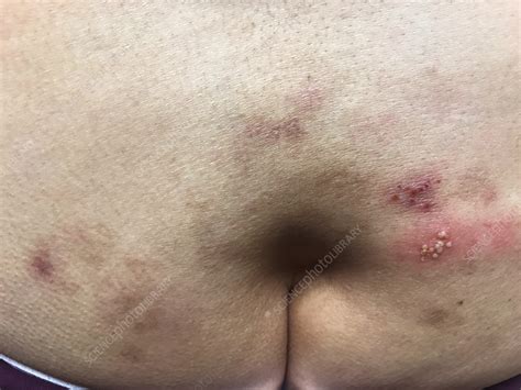 Herpes Simplex On Buttocks