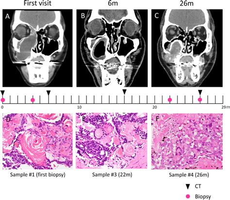 Ghost Cell Odontogenic Carcinoma Arising In Dentinogenic Ghost Cell