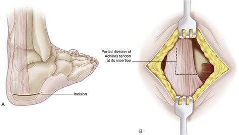 32 Posterior Tendon Transfer to the Os Calcis for Correction of Calcaneus Deformity (Green and ...