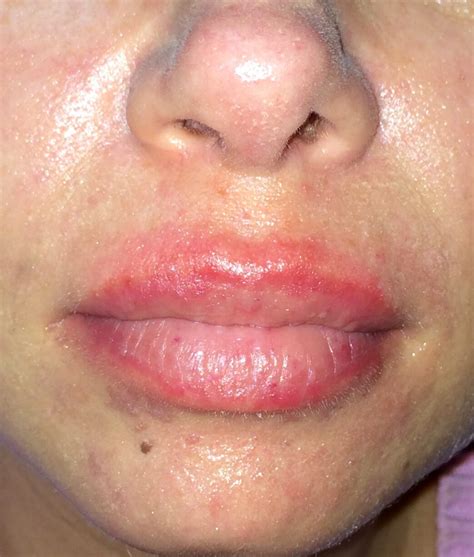 What Do Hives On Lips Look Like