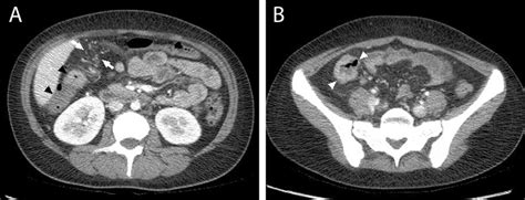 Imaging Findings That Support A Diagnosis Of Either Crohn Disease Or