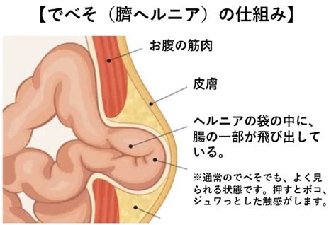 臍ヘルニア｜足立区で皮膚科・小児科なら五反野皮ふ・こどもクリニック｜土日診療