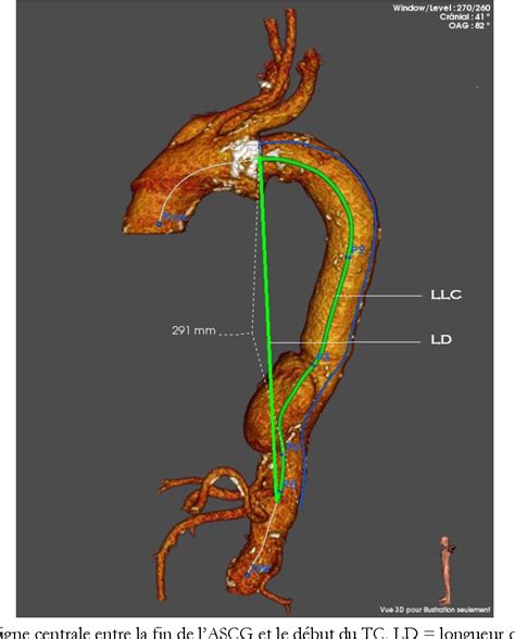 Figure From Traitement Endovasculaire Des An Vrismes De L Aorte