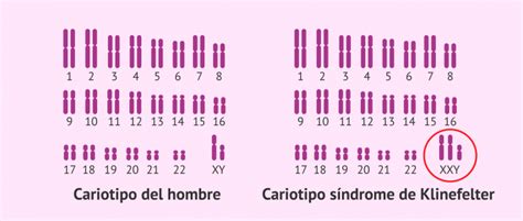 Cariotipo normal y cariotipo con síndrome de Klinefelter