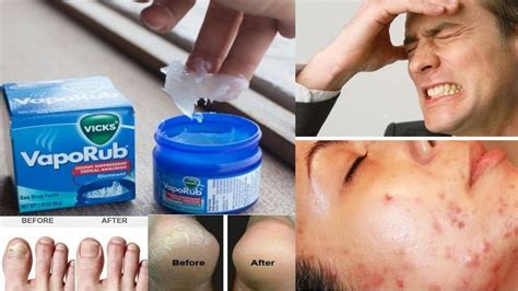 Surprising Uses for Vicks VapoRub | 8 Amazing Uses & Benefits of Vicks ...