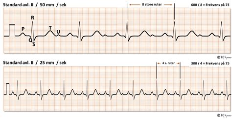 Index Of Elaring Fag Hjertesykdommer Spl Ekg Del Images