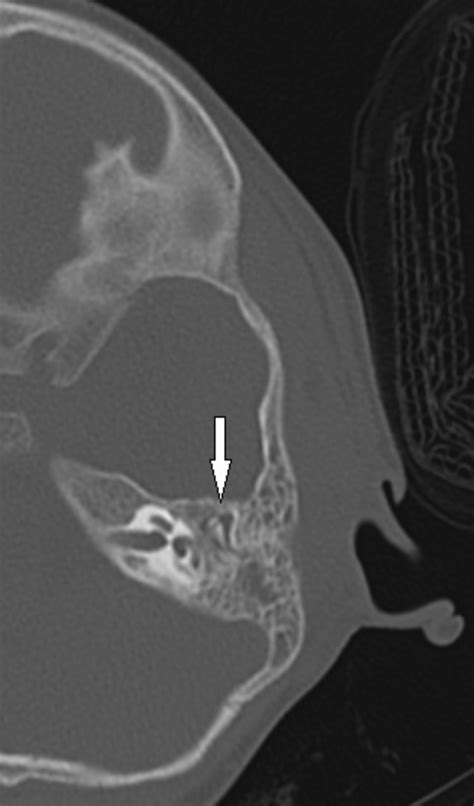 Congenital Cholesteatoma Axial Image Shows Soft Tissue Density White