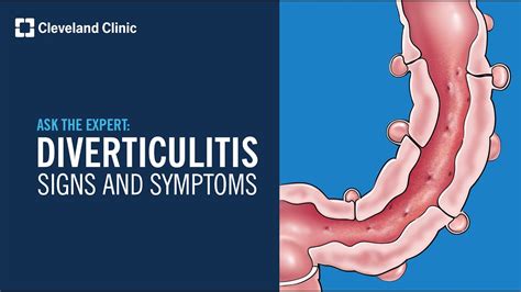 Warning Signs Of Diverticulitis Ask Cleveland Clinics Expert Youtube