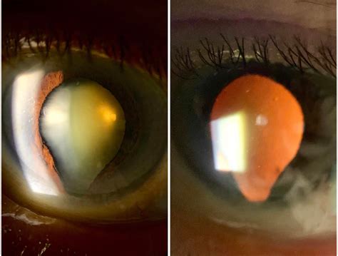 Iris Coloboma : r/WTF