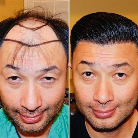 Best Hair Transplant Results