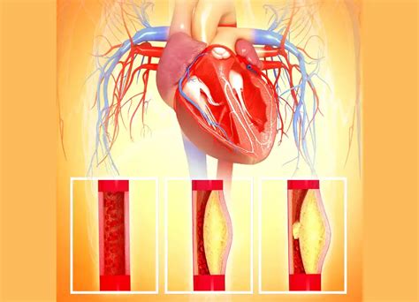 ¿qué Son Las Enfermedades Cardiovasculares Biosnova