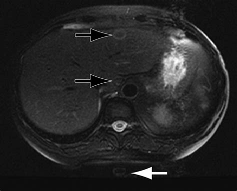 Normal Mri Appearance And Motion Related Phenomena Of Csf Ajr