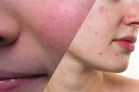 Acne Rosacea Vs Acne Vulgaris