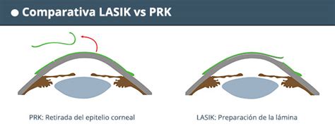 Diferencias Entre Lasik Y Prk Verte Oftalmolog A Barcelona