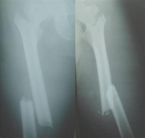 Figure 1 From Bilateral Intertrochanteric And Femoral Diaphyseal