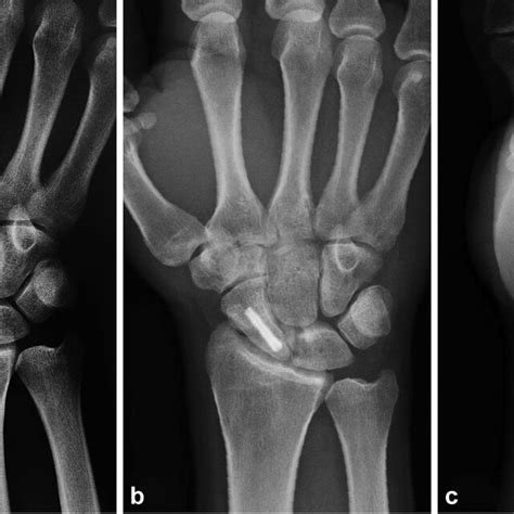 Pre And Postoperative Radiographs Of A Scaphoid Nonunion With Avascular