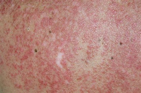 Lupus Rash On Back Triggered By Sun Photograph By Dr P Marazzi Science Photo Library