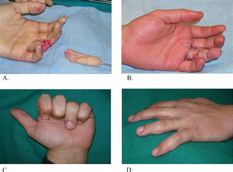 Figure 1 From Finger Replantations After Ring Avulsion Amputations