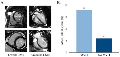 Microvascular Obstruction In St Segment Elevation Myocardial Infarction