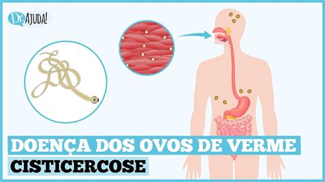 CISTICERCOSE O QUE É SINTOMAS DIAGNÓSTICO TRATAMENTO E PREVENÇÃO