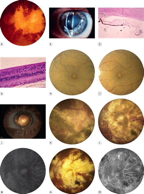 Inflammatory Diseases of the Retina | Ento Key