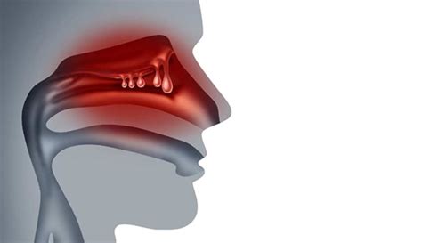 Nasal Polyps - OC ENT Clinic | Sinus Surgery | Septoplasty ...